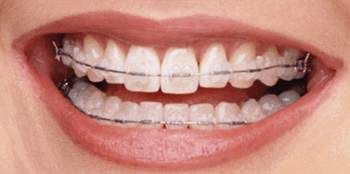 Proteza za zube i mogući problemi