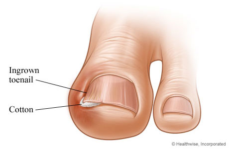 Urasli nokti – Kako sprečiti i lečiti ovu pojavu