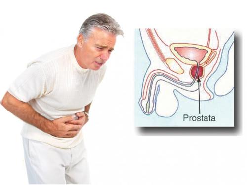 Šta je prostata i koje su simptomi upale prostate