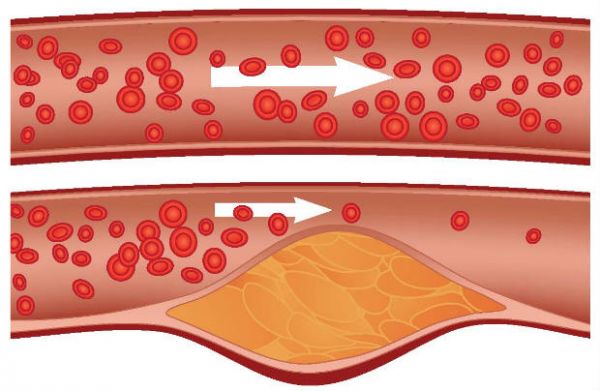 Ateroskleroza koronarnih arterija